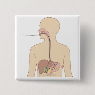 Endoscoop Vierkante Button 5,1 Cm