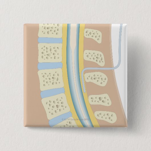 Epidurale anesthesie vierkante button 5,1 cm (Voorkant)