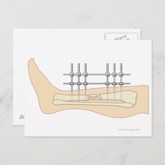 Externe fixator briefkaart (Voorkant / Achterkant)