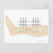 Externe fixator briefkaart (Voorkant)