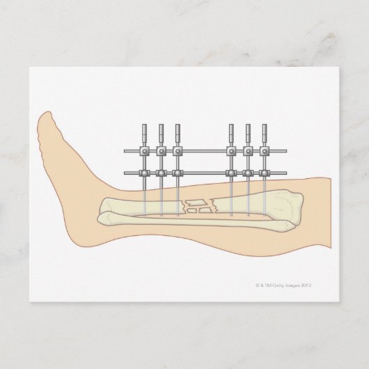 Externe fixator briefkaart (Voorkant)