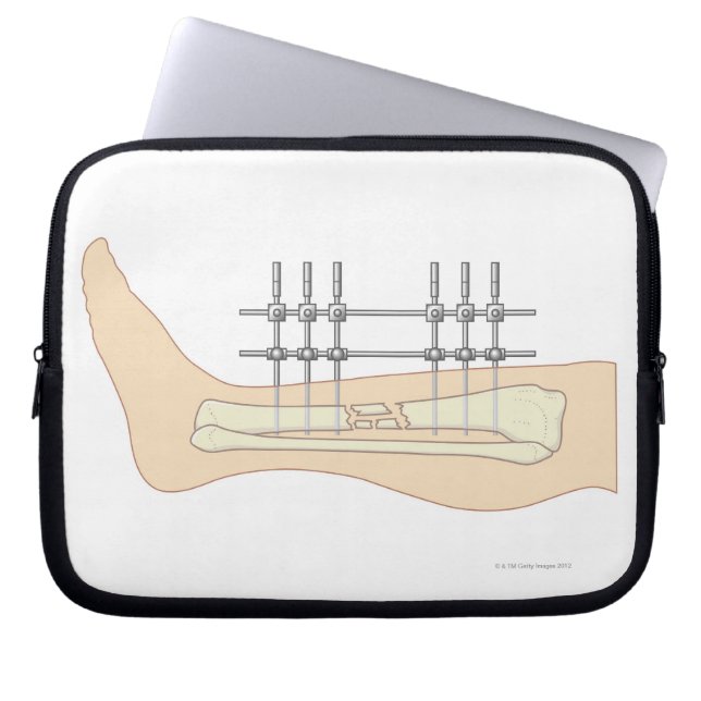 Externe fixator laptop sleeve (Voorkant)