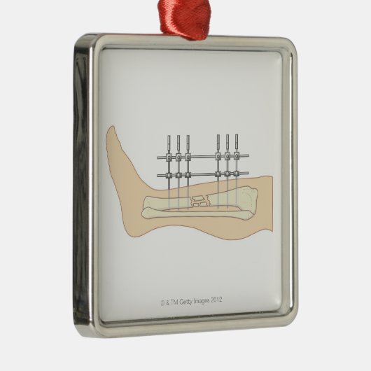 Externe fixator metalen ornament (Rechts)