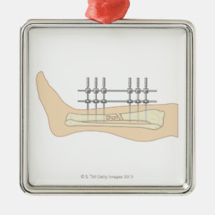 Externe fixator metalen ornament
