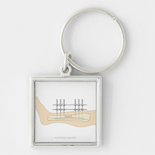 Externe fixator sleutelhanger (Voorkant)