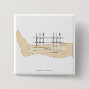 Externe fixator vierkante button 5,1 cm