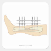 Externe fixator vierkante sticker (Voorkant)
