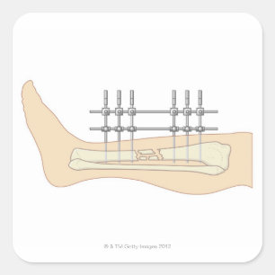 Externe fixator vierkante sticker