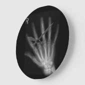 Extra Digit Röntgenfoto Rechterhand Grote Klok (Hoek)