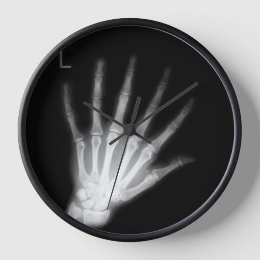 Extra Digit X-ray Left Hand (Voorkant)