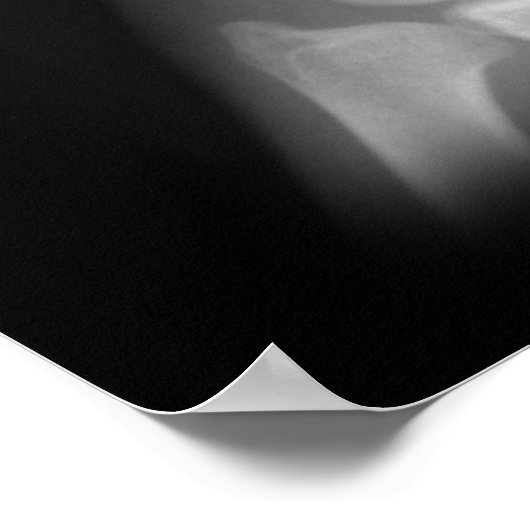 Extra Digit X-ray Left Hand Poster (Hoek)