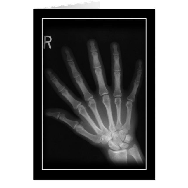 Extra Digit X-ray Right Hand (Voorkant)
