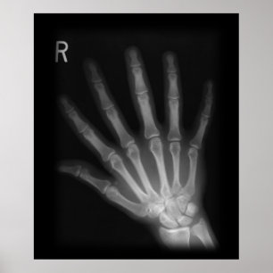 Extra Digit X-ray Right Hand Poster
