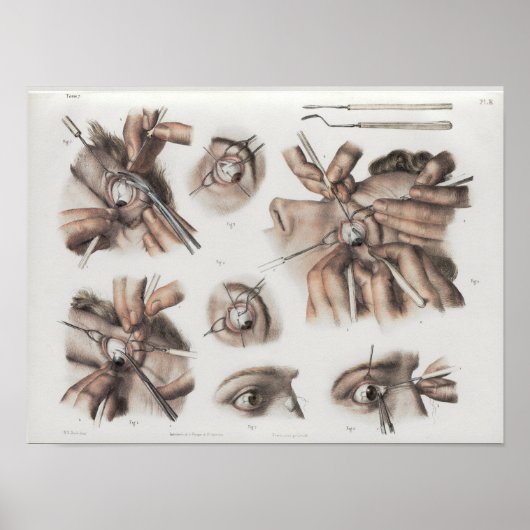 Eye Surgery Optometry Vintage Anatomy Print (Voorkant)
