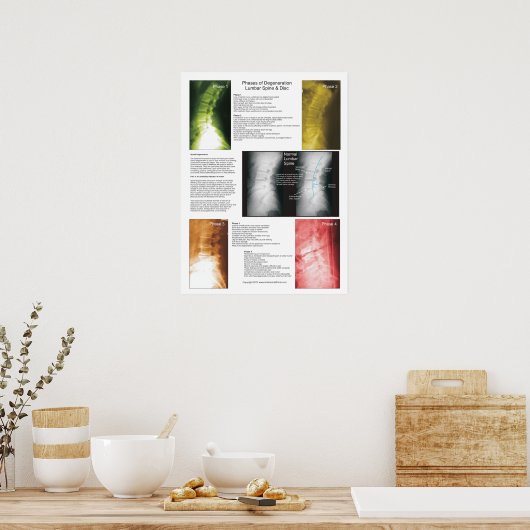 Fasen Lumbar Spinal Degeneration Poster (Keuken)