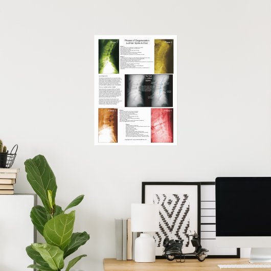 Fasen Lumbar Spinal Degeneration Poster (Thuiskantoor)