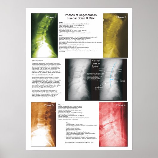 Fasen Lumbar Spinal Degeneration Poster (Voorkant)