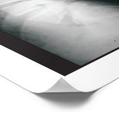 Fasen Lumbar Spinal Degeneration Poster (Hoek)