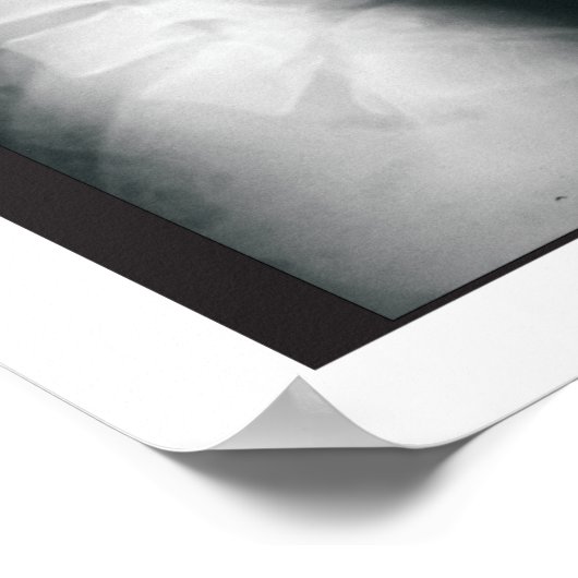 Fasen Lumbar Spinal Degeneration Poster (Hoek)