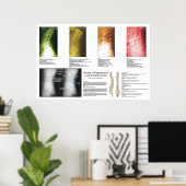 Fasen Lumbar Spinal Degeneration Poster (Thuiskantoor)