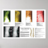 Fasen Lumbar Spinal Degeneration Poster (Voorkant)