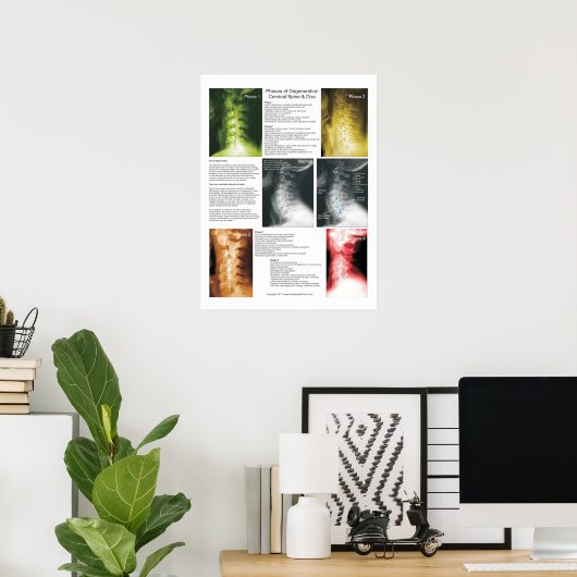 Fasen Poster van cervicale Spinale degeneratie (Thuiskantoor)