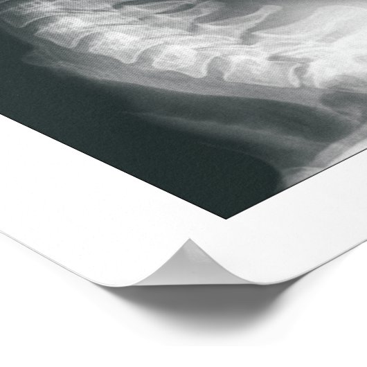 Fasen Poster van cervicale Spinale degeneratie (Hoek)