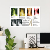 Fasen Poster van cervicale Spinale degeneratie (Thuiskantoor)