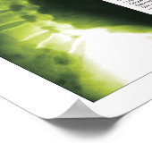 Fases Cerical Lumbar Spinal Degeneration Poster (Hoek)