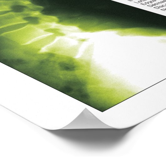 Fases Cerical Lumbar Spinal Degeneration Poster (Hoek)