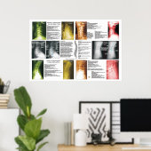 Fases Cerical Lumbar Spinal Degeneration Poster (Thuiskantoor)