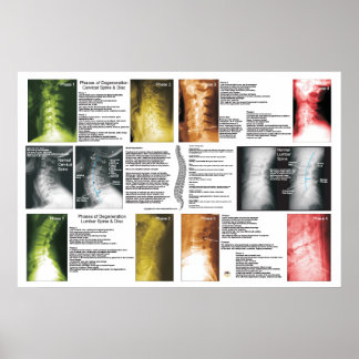 Fases Cerical Lumbar Spinal Degeneration Poster