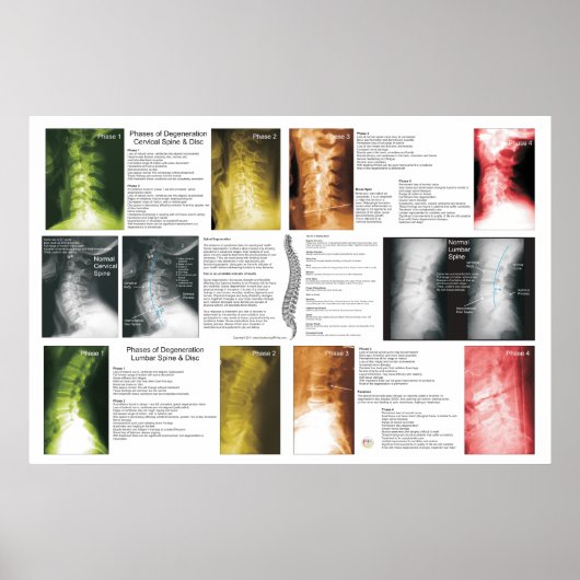 Fases Cerical Lumbar Spinal Degeneration Poster (Voorkant)
