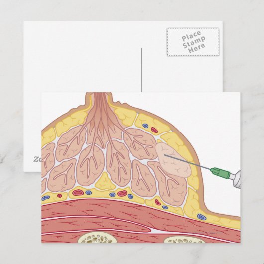 Fijnnaald Aspiratie Briefkaart (Voorkant / Achterkant)