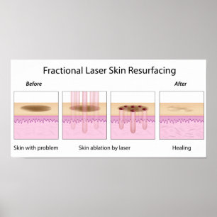 Fractionele laserhuid Poster herrijzen