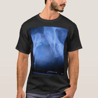 gebroken dijbeen t-shirt