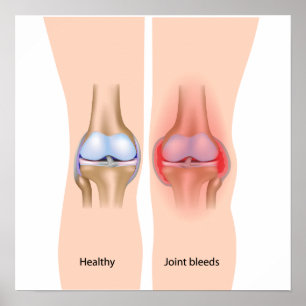 Gewrichtsbloedingen bij hemofilie Poster