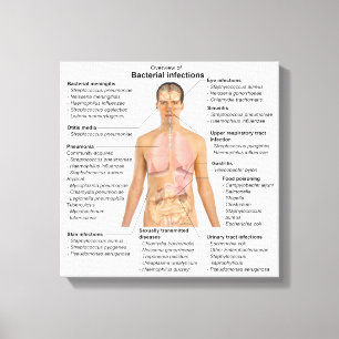 Grafiek van de bacteriële infecties bij de mens canvas afdruk