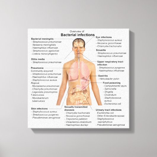 Grafiek van de bacteriële infecties bij de mens canvas afdruk (Voorkant)