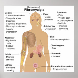Grafiek van de symptomen van fibromyalgie poster