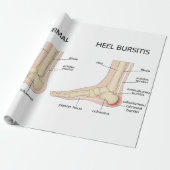 Haglund-misvorming Cadeaupapier (Uitgerold)