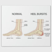 Haglund-misvorming Cadeaupapier (Vlak)