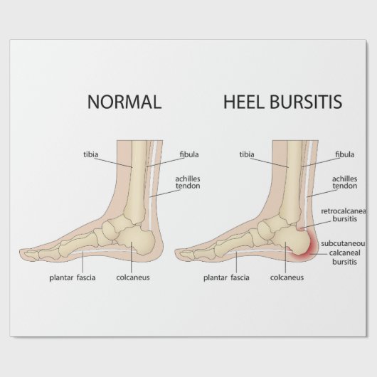 Haglund-misvorming Cadeaupapier (Vlak)