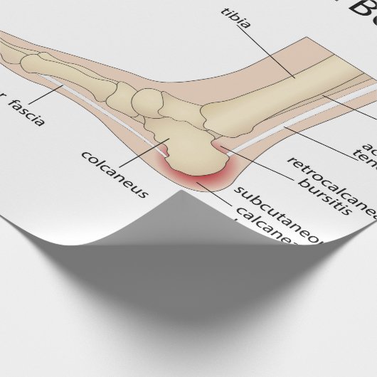 Haglund-misvorming Cadeaupapier (Hoek)