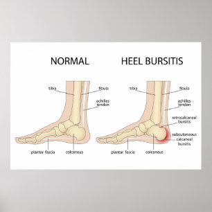 Haglund-misvorming Poster