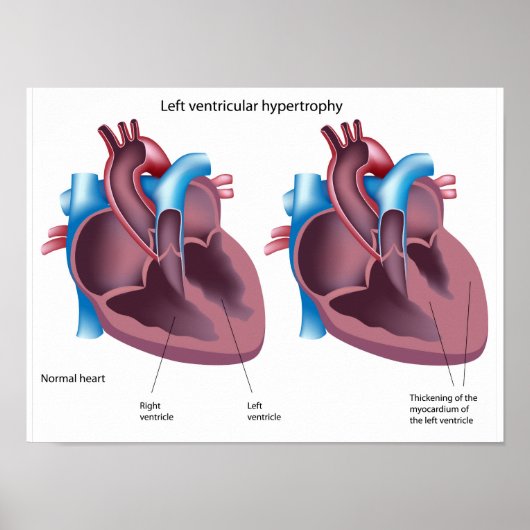 Harthypertrofie Poster (Voorkant)