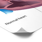 Harthypertrofie Poster (Hoek)