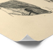 hernia Anatomy 1880 Afdruk Poster (Hoek)