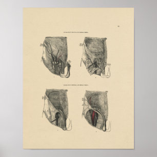  hernia Anatomy 1880 Afdruk Poster