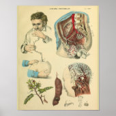 Hersenchirurgie Hoofd Anatomie Kunstdokter Afdrukk Poster (Voorkant)